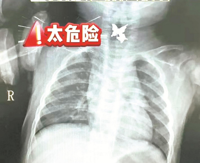 9月龄女婴误吞耳钉 医院5分钟化险为夷 - 憨鼠网