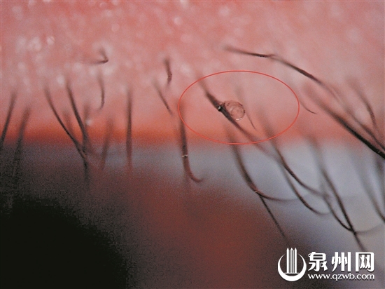 睫毛长虱子 遭蚂蚁叮咬皮肤溃烂 夏天活动防被咬 - 憨鼠网